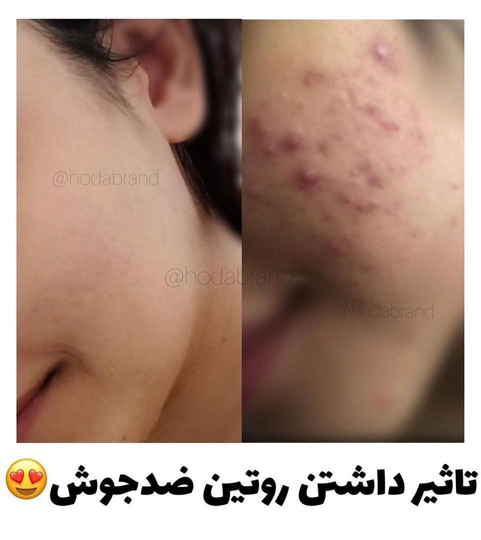 پک ضدجوش تخصصی بیوآکوا