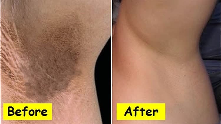 برف سفید کننده بدن نقاط حساس مویام MOOYAM Snow Bleach