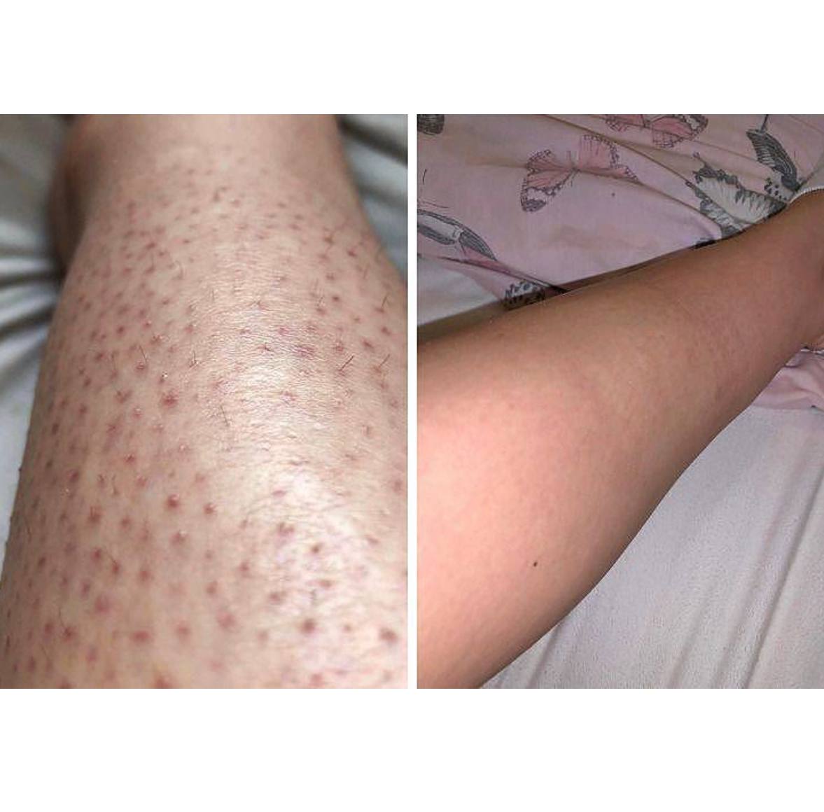 پک تخفیفی نمک اسکراب بدن + کرم آمونیوم 12٪