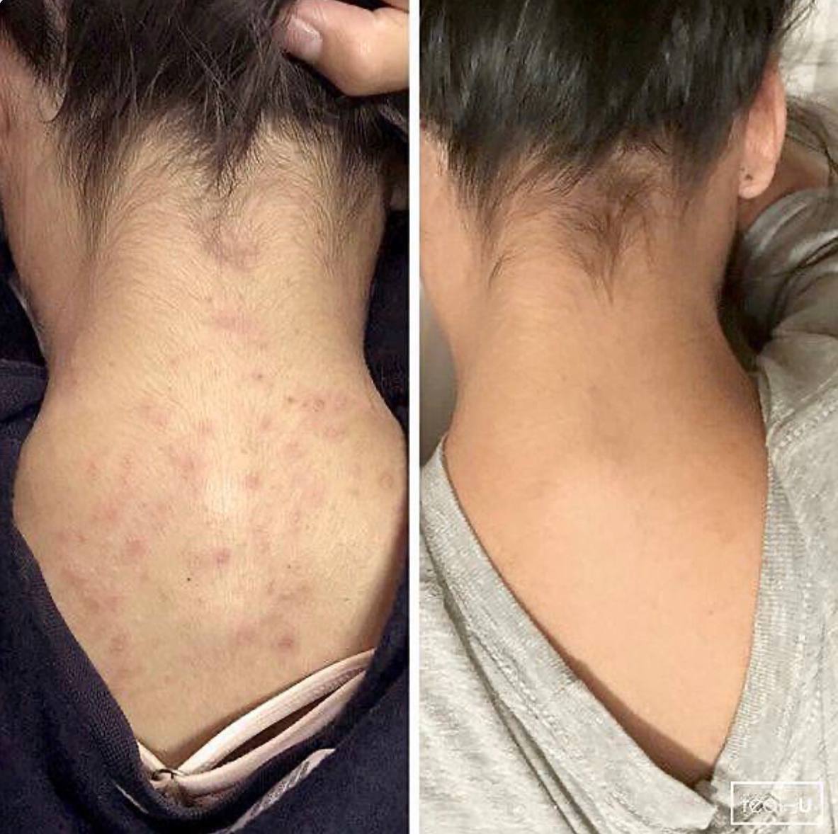 اسپری ضدجوش بدن نوآکنه