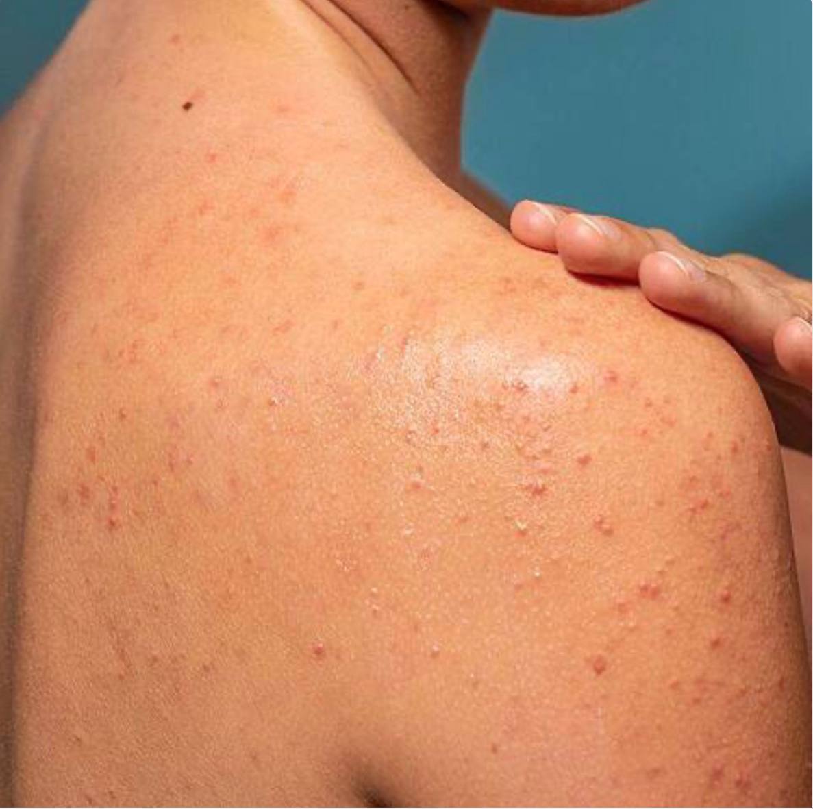 اسپری ضدجوش بدن نوآکنه