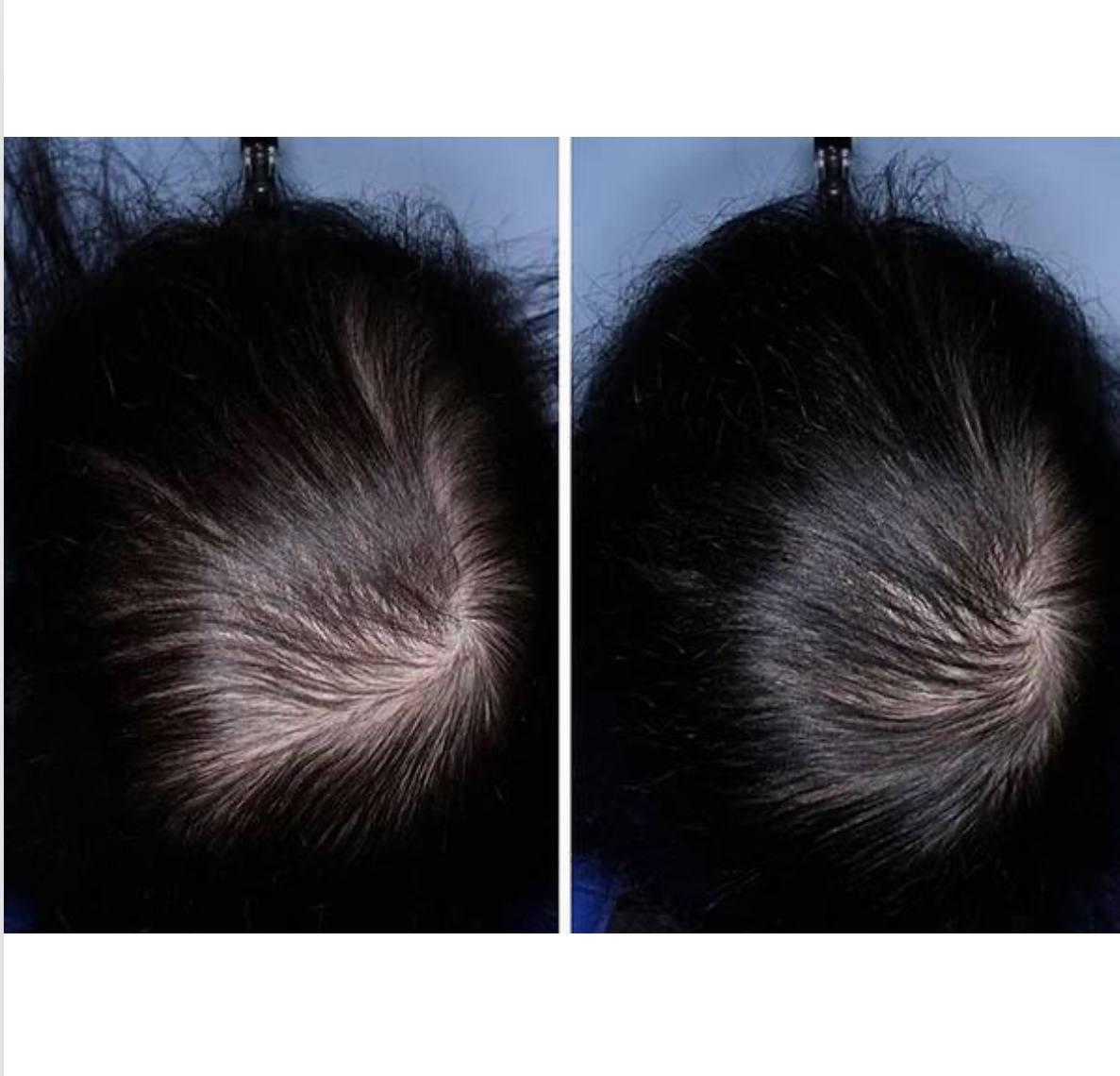 ویال ضدریزش مو کوئین مدل PROTEIN KERATIN