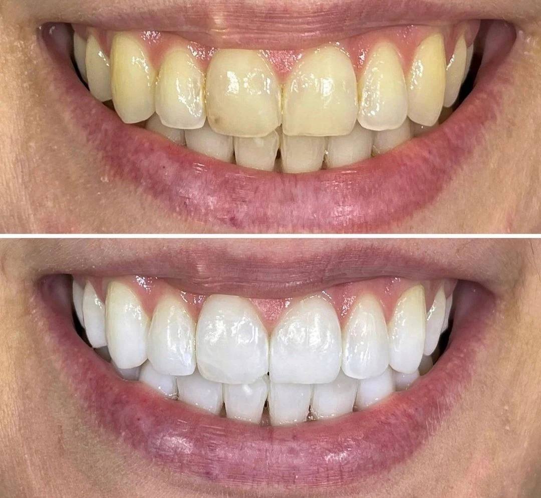 فوم سفید کننده دندان اسمایل کیت | smilekit v34