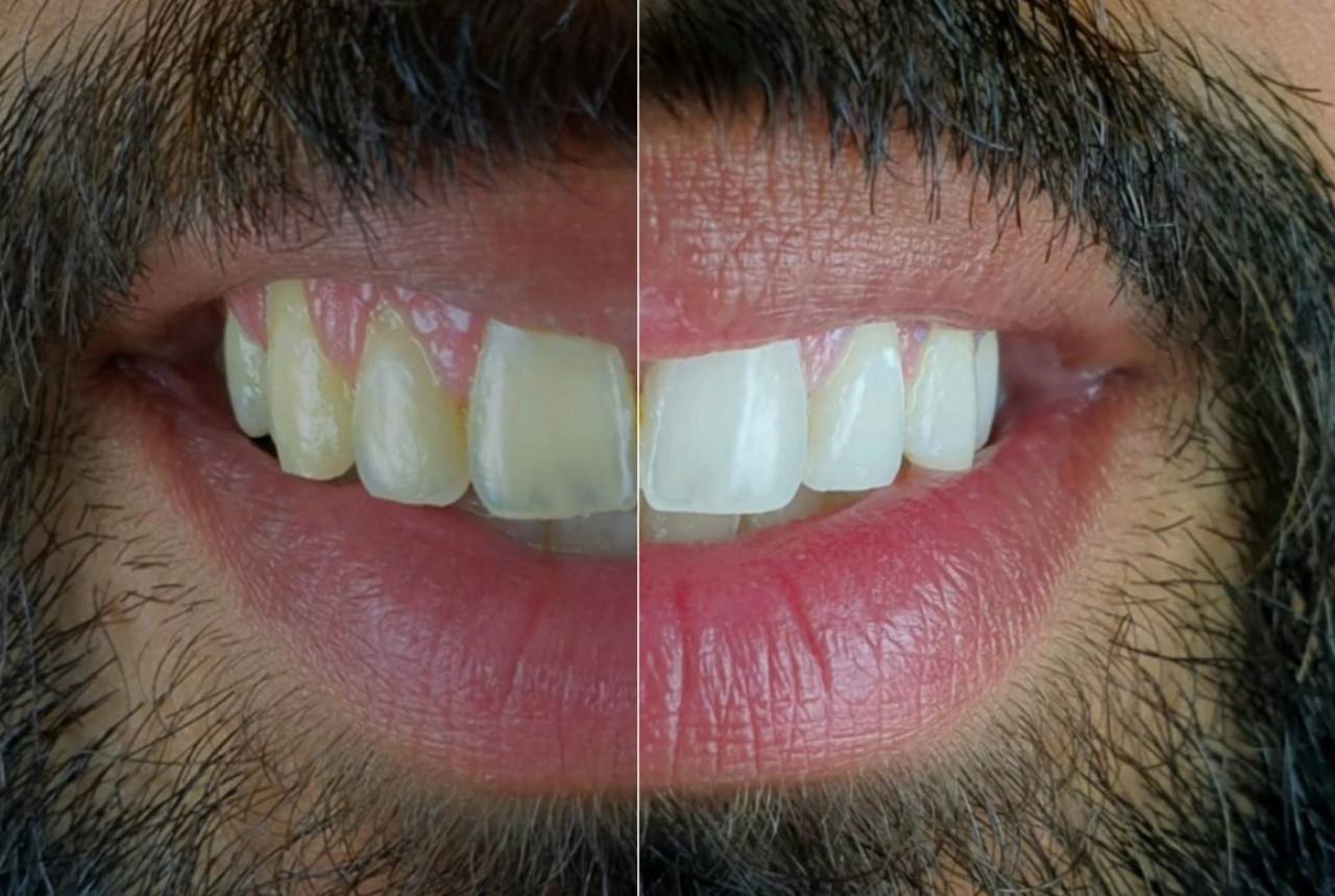 فوم سفید کننده دندان اسمایل کیت | smilekit v34