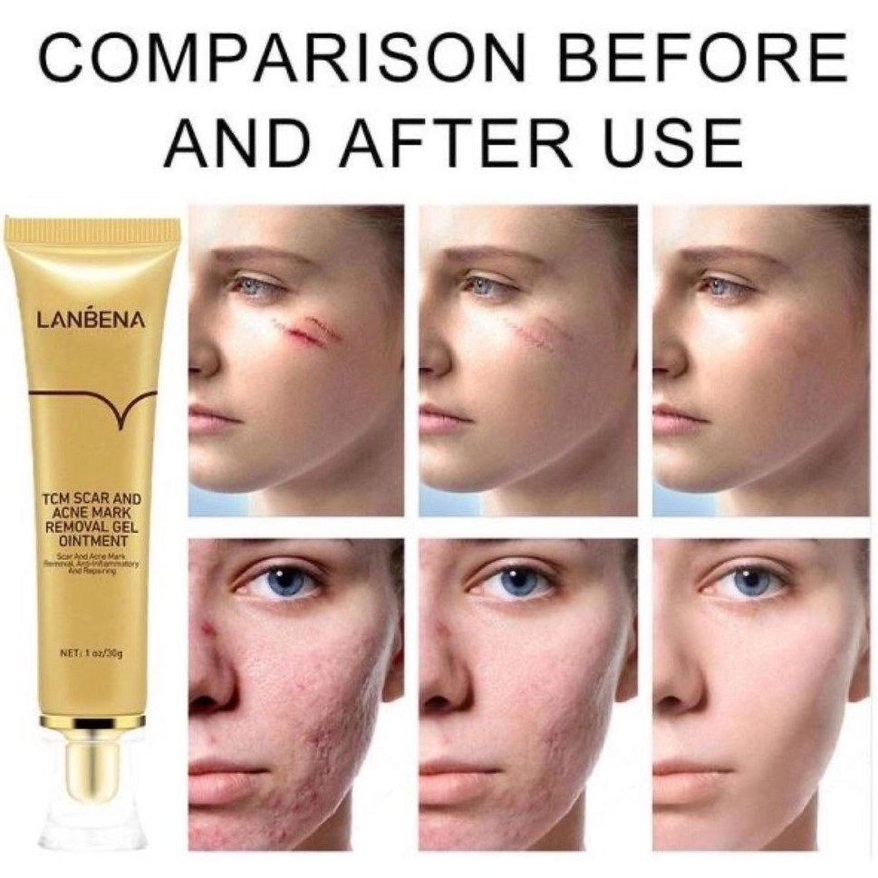 ژل ترمیم کننده جای جوش و اسکار لانبنا LANBENA