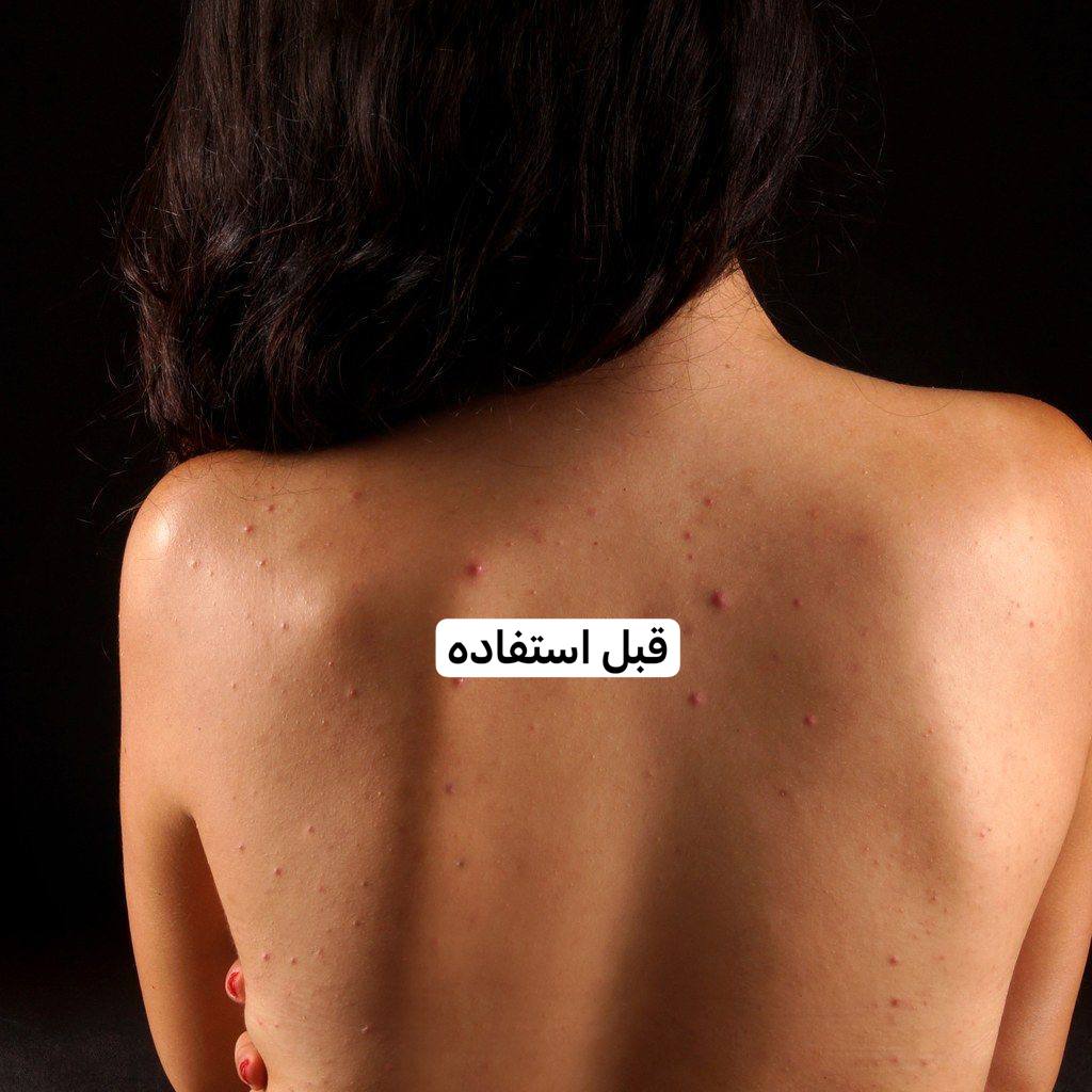پک تخفیفی نابود کننده جوش بدن در 14 روز
